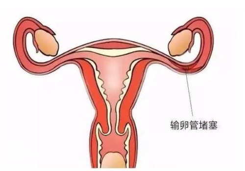 子宫肌瘤会自愈吗？为什么会患有子宫肌瘤？